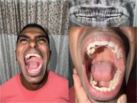 मलेसियाका पुरुषको मुखमा ४२ दाँत, गिनिज वर्ल्ड रेकर्डमा नयाँ कीर्तिमान