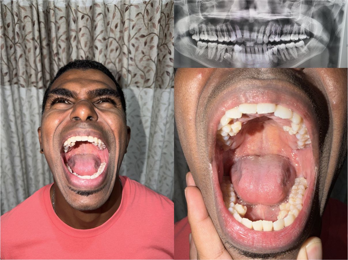 मलेसियाका पुरुषको मुखमा ४२ दाँत, गिनिज वर्ल्ड रेकर्डमा नयाँ कीर्तिमान