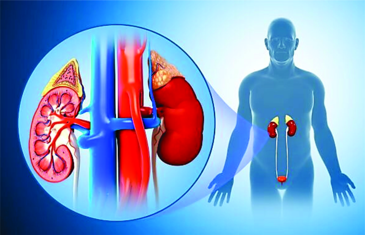 बढ्दो मृगौला रोग र सावधानीका उपाय